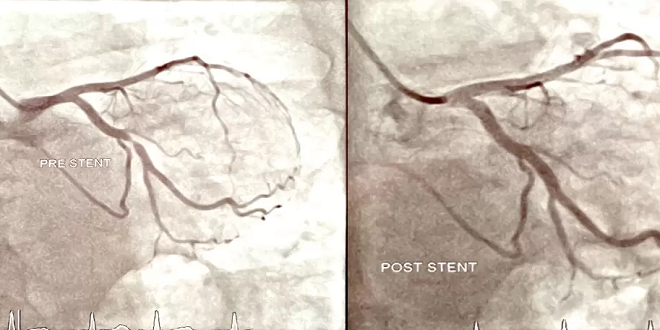 What is the Minimum Cost of Coronary Angiography in Delhi?